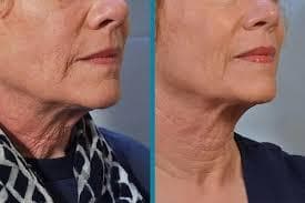 Radiofrequency Skin Tightening: What you need to know?